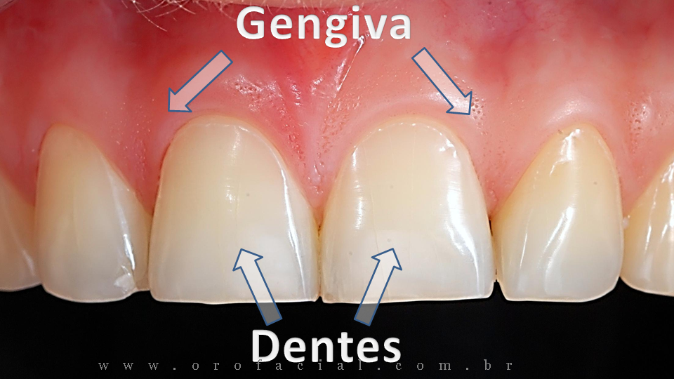Dentes e Gengiva