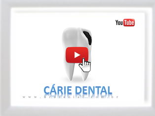 Vídeo Sobre Cárie Dentária