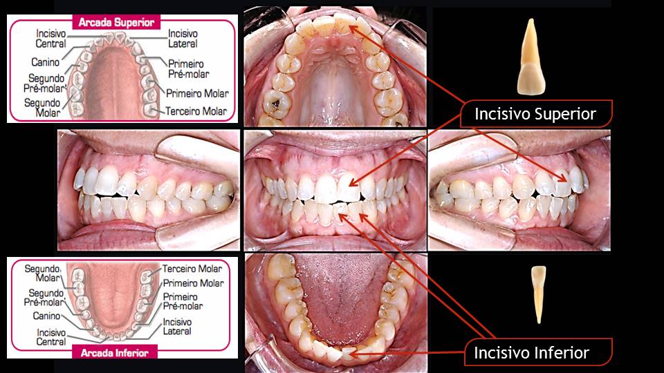 Quais dentes temos Dentes Incisivos