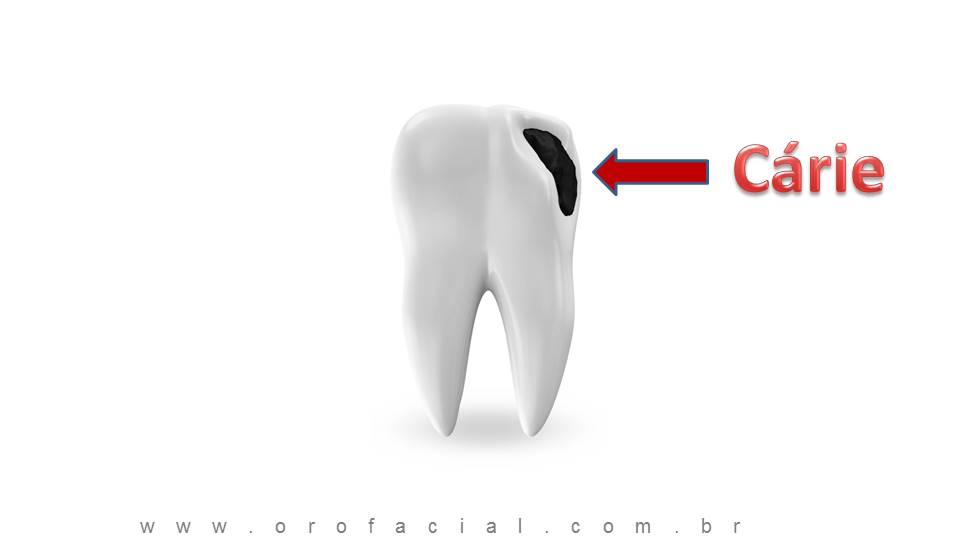 Cárie Dental