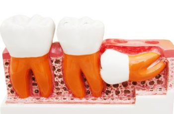 Orofacial #29 –  Dentes do Siso (“Dente do Juízo”): Feliz Quem Não Os Têm