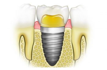 Orofacial #32 – Implantes Dentários – Alguns Conceitos Básicos