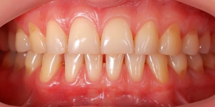 Orofacial #68 – Apertando os Dentes e Bruxismo: Agentes Agressores aos Dentes e Periodonto que Prejudicam a Saúde de Dentes e Gengivas