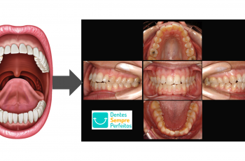 Orofacial #81  – Cárie Dental – Você Já Viu Isso?
